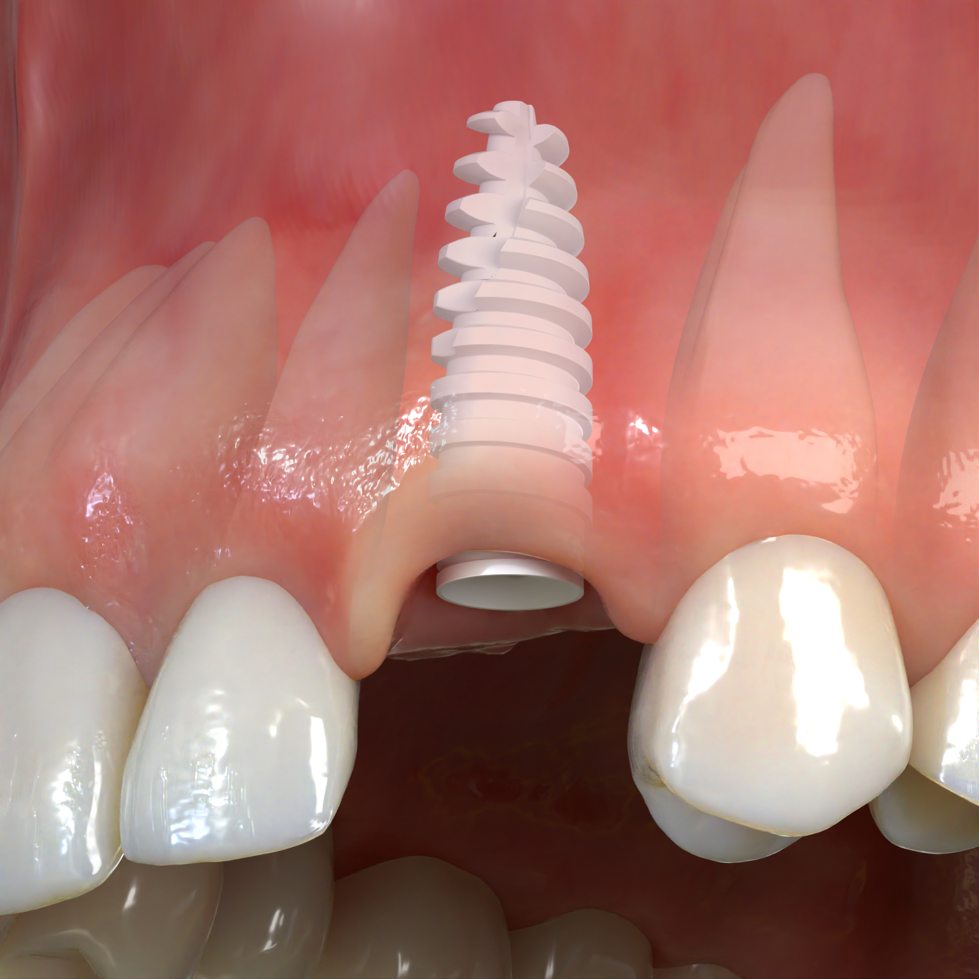 Implants